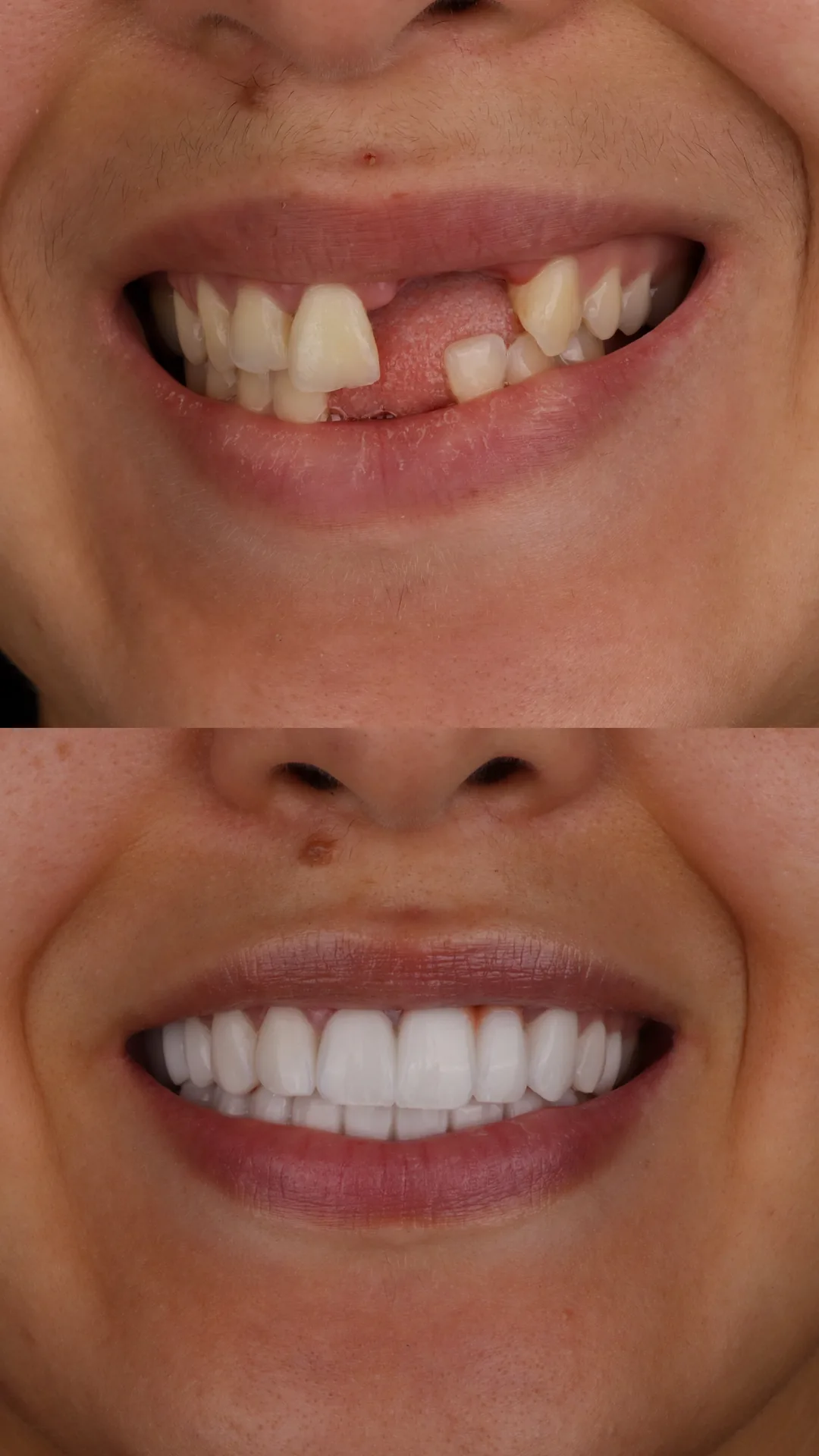 Before and after: upper front teeth restored with dental crowns by Dra. Lesly Pinto in Medellín